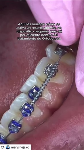 Orthodontics Online on Instagram: "By @marycheje.ec 🇺🇸 Activating an Open Coil Spring to Create Space in Orthodontics In this video, I show you how an open coil spring is activated, a small but super efficient device used in orthodontic treatment. Open coil springs are placed on the archwire and generate a light, continuous force that helps create space between teeth, whether for alignment, correcting rotations, or preparing the area for the proper positioning of a tooth. They’re a safe, contr