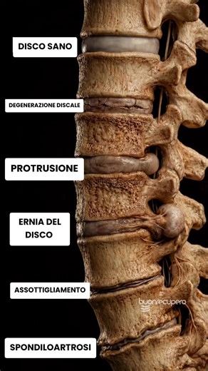 Hernias or protrusions? What's happening to your spine? See the first comment ⚠️ #shorts