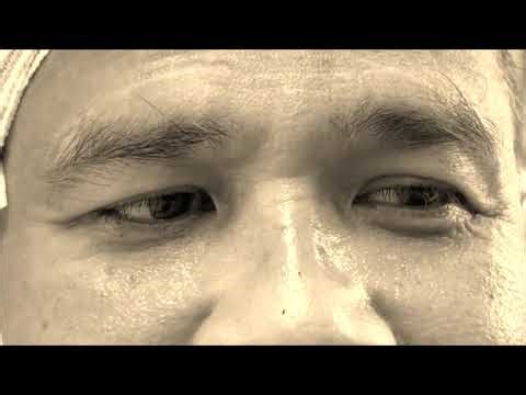 Jerk Nystagmus from Right Labyrinthitis