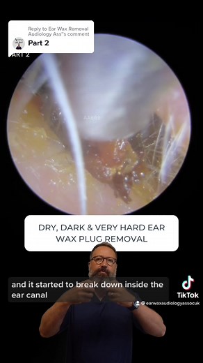 Dry and Hard Ear Wax Removal - Part 2