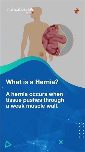 A Small Bulge Could Be a Hernia