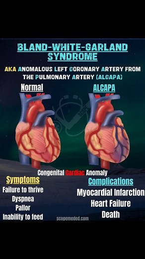 CardioVisual: Powered by MedicalVisual on Instagram: "Bland-White-Garland syndrome AKA Anomalous Left Coronary Artery from the Pulmonary Artery (ALCAPA) is a congenital cardiac defect that occurs in approximately 1 in every 300,000 births. The left coronary artery is important as it brings oxygen rich blood to the anterior part of the heart. In ALCAPA, the left coronary artery branches off of the pulmonary artery instead of the aorta. This brings deoxygenated blood to the heart. Symptoms: Failur