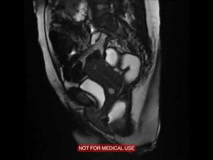MR defecogram pelvic floor herniation with rectocele