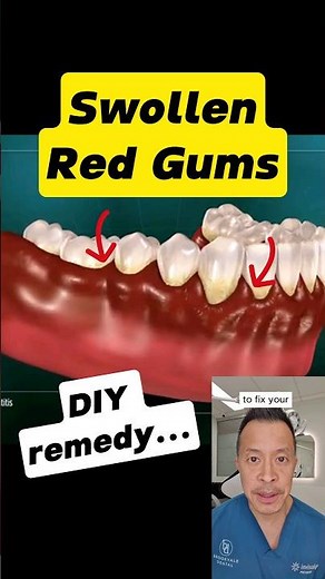 Red, Sore Gums? Fix Them in 3 Easy Steps! #dentallan #dentist #shorts