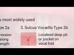 SULCUS VOCALIS