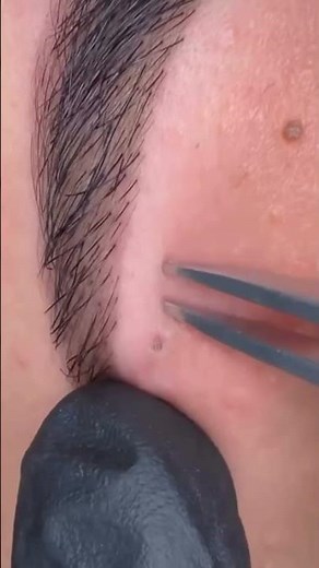 another facial another blackhead #facial #blackheads #skin #estheticianlife #belleza #fyp