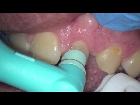 Plaque what is it and how does it grow