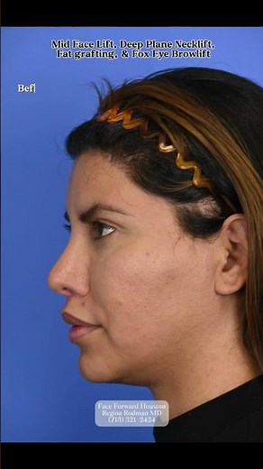 Brow Lift| Mid Face Lift| Facial Plastic Surgery Texas