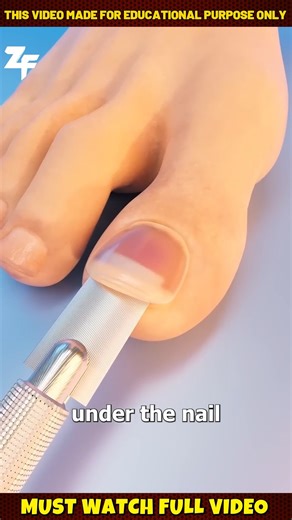 Zation Facts on Instagram: "How Doctors Remove Toenails 禮 | 3D Animation Explained . . . 3D Animation Explained Toenail Removal Animation Medical Procedures Explained Foot Care 3D Animation Doctor Explained 3D Surgery Animation Explained #3DAnimation #Explained #MedicalFacts #ToenailRemoval #FootCare #MindBlowingFacts #Shorts #AnimationExplained #ViralVideo #ScienceExplained #zackdfilm #zackdfilms #professorofhow #InstagramReels #FacebookViral #FBReels"