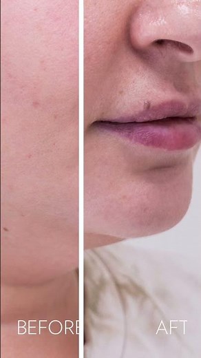Before and After CoolSculpting
