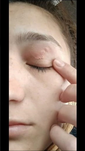 Images in Clinical Medicine: Serpiginous Lesion in the Left Upper Eyelid