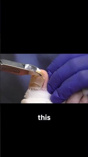Watch a Toenail Removal and Cleaning Like You've Never Seen! #ToenailRemoval #FootCareTips