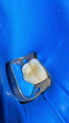 Deep Caries but Nerve Saved | Molar Restoration