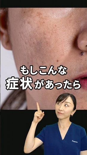 【肝斑】まず試すべき成分を皮膚科医が解説