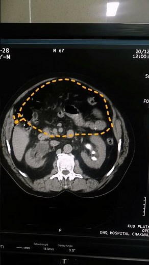 Hydronephrosis | Findings of kidney | Scan of kidney | Medical Imaging | CT Scan | Calculi of kidney