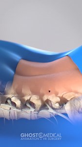 The OptiLIF® Endo System by Spineology Inc. is a groundbreaking approach to lumbar interbody fusion procedures. Ghost Medical is proud to h | The Visual Surgery