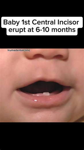 7.5K views · 34 reactions | Milk tooth or Baby tooth Typically erupts at 6 months to 3 years old. #irumadentalclinic #oralhealth #milktooth #tips #question #pov #dental #dentalclinic #dentalhealth #eruptingtooth #trendingreelsvideo #trend #needtoknow #oral #oralcare #milestone #babytooth | Iruma Dental Clinic | Facebook