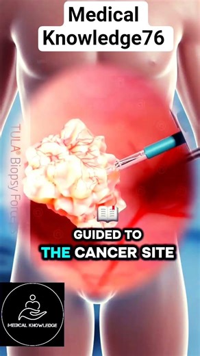 What It is Bladder Cancer and How Doctors Treat It?