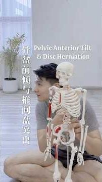 Backbend to Forward Fold: Insights on Anterior Pelvic Tilt and Disc Herniation