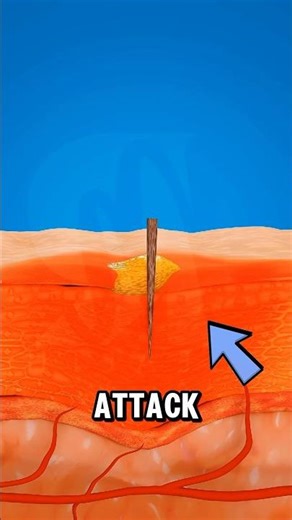 Why Tiny Splinters Hurt So Much! 🪵