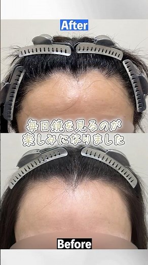 【40代女性】生え際を整えて自由に髪型を楽しむには #植毛 #自毛植毛