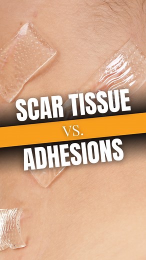 3.4K views · 86 reactions | Scar Tissue vs. Adhesions: What’s the...