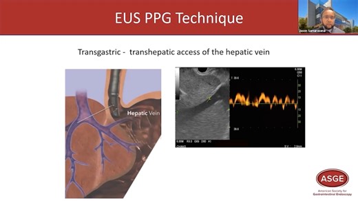 Jason Samarasena, MD discusses endoscopic ultrasound-guided portal pressure measurement. View the full series of video tips in GI Leap at Learn.ASGE.org. Sponsored by Braintree. #GIEndoscopy #Endoscopy | American Society for Gastrointestinal Endoscopy - ASGE | Facebook