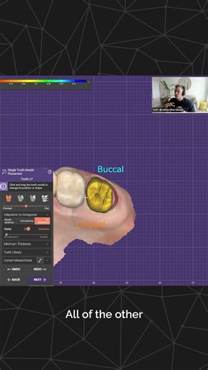exocad Training Session - Seth Potter