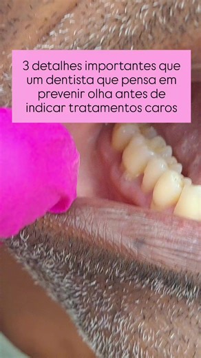 Antes de indicar tratamentos caros, um dentista que pensa em prevenção observa detalhes que mudam completamente o plano. 🔍 1. Padrão de desgaste dos dentes Não é só quanto o dente desgastou, mas como. Desgastes planos, trincas, fraturas e polimentos anormais contam a história das forças que esse dente recebe todos os dias. 🧠 2. Hábitos e rotina do paciente Apertamento, bruxismo, estresse crônico, sono ruim, excesso de cafeína… Se esses fatores continuam ativos, qualquer tratamento sofisticado 