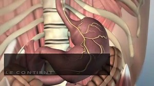 Hernie hiatale : traitement, chirurgie, causes, symptômes, qu'est-ce que c'est ?