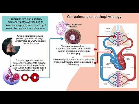 Pathophysiology of cor pulmonale