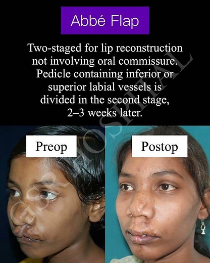 Abbé Flap for Lip #reconstructivesurgery at #GSRHospital