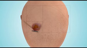 File:The-Golden-Spiral-Flap-A-New-Flap-Design-that-Allows-for-Closure-of-Larger-Wounds-under-Reduced-Video 1.ogv - Wikimedia Commons