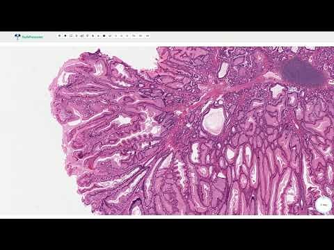 Peutz-Jeghers Polyp - Histopathology