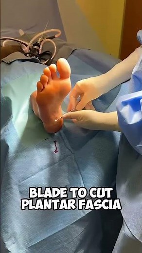 Plantar Fasciitis Surgery: A Step-by-Step Visual Guide #amazing
