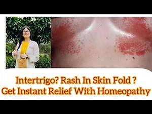 Rash In Skin Fold ? Intertrigo? Best Homeopathic Medicine For groin rash ? Toe rash ? Breast Rash