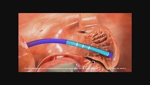 Watchman Implantation: Tips and Tricks