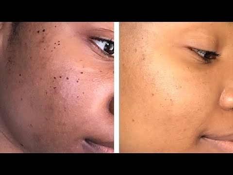 DPN Removal on My Face
