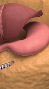 This video shows the Sleeve Gastrectomy surgery for the stomach reduction