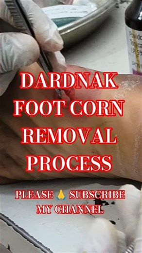 Pair Ke Corn Ko Nikalne Ka Sahi Tarika #shorts