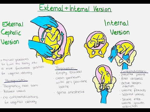 Turning the Baby in Pregnancy: External and Internal Cephalic Version Explained