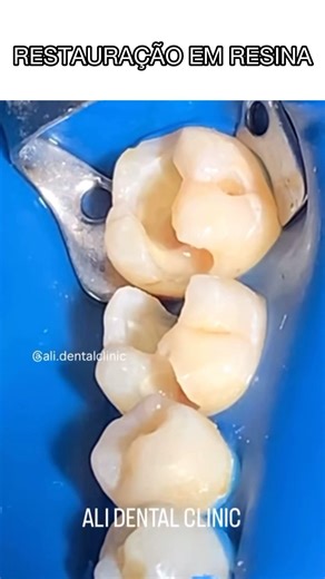 Restauração em Resina #shortsvideo#shortsreel#videoviral#oral#odontologia#dentista#restauracao#short