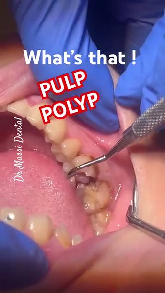 PULP POLYP , Irreversible PULPITS