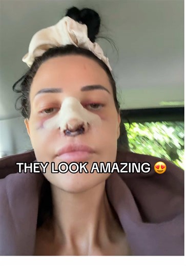 My Breast Surgery Experience: 500cc Implants