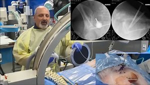 Sacroplasty Access Using the Short Axis Technique