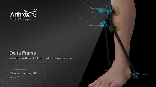 Delta Frame With the ArthroFX® External Fixation System