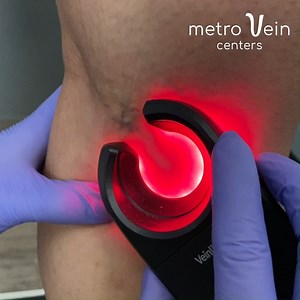 2.5K views · 26 reactions | Have you ever used a vein finder? They're simple, yet very effective infrared lights that are used to pinpoint the exact spot where veins can be treated. | Metro Vein Centers | Facebook