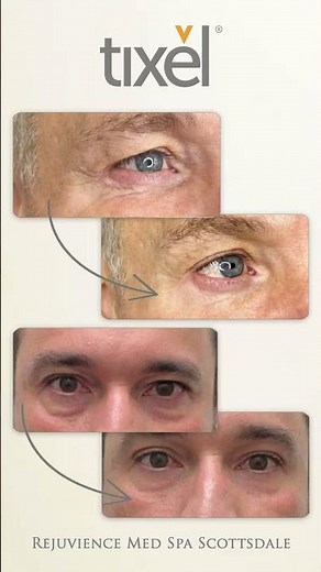 Tixel Non-Surgical Eye Lift | Scottsdale Eye Rejuvenation