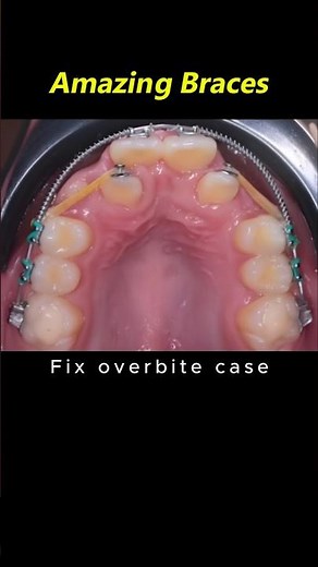 Amazing braces. Fix buck teeth process #braces #orthodontist #dentist