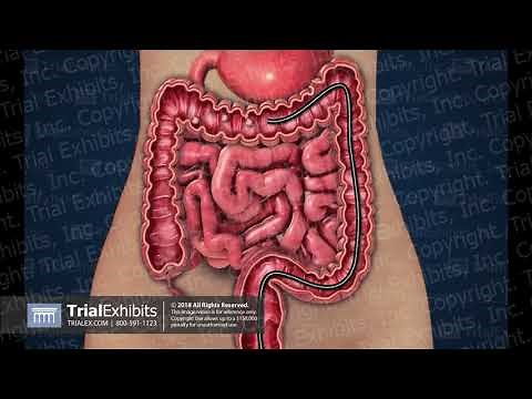 Colonoscopy - Polyp Removal